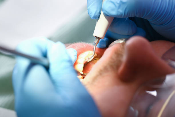 Best Emergency Dental Care for Broken or Chipped Teeth in Mi Wuk Village, CA